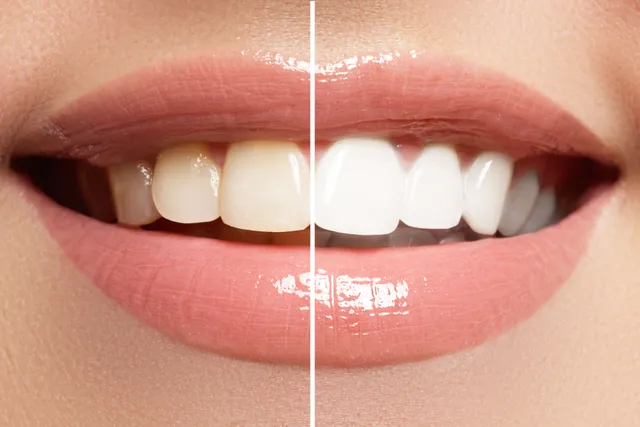 Blanqueamiento dental en la Clínica Andos Dental de Boadilla del Monte