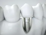Implantes dentales en la Clínica Andos Dental de Boadilla del Monte
