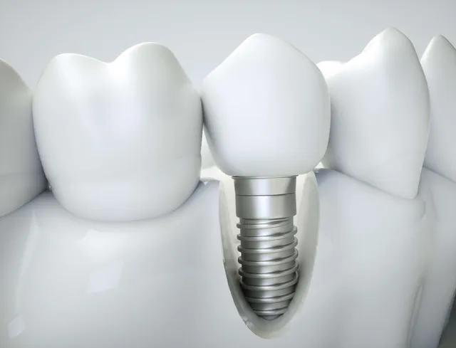 Implantes dentales en la Clínica Andos Dental de Boadilla del Monte