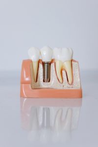 Implante dental